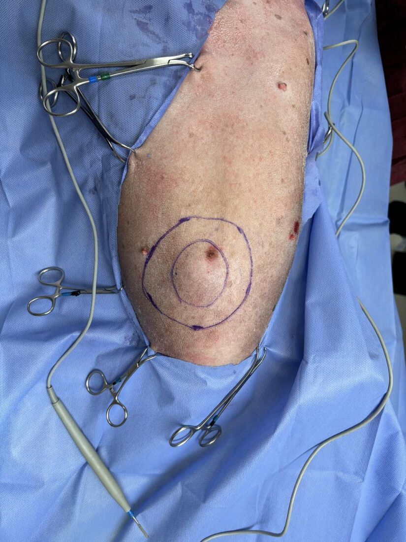 avance-sarcoma-2